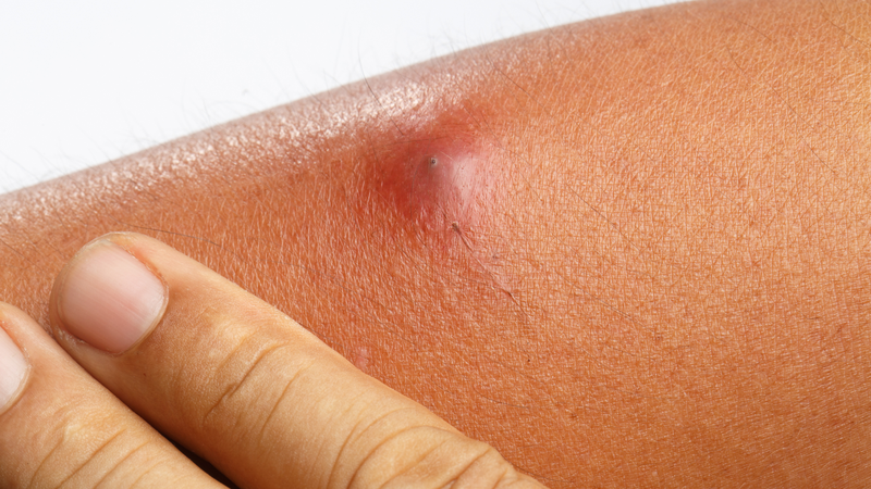 Người bị áp xe kiêng ăn gì để vết mủ mau lành?5