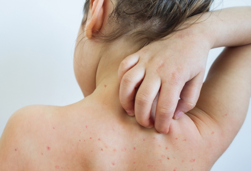 Người bị bệnh sởi kiêng gì và cần làm những gì 1