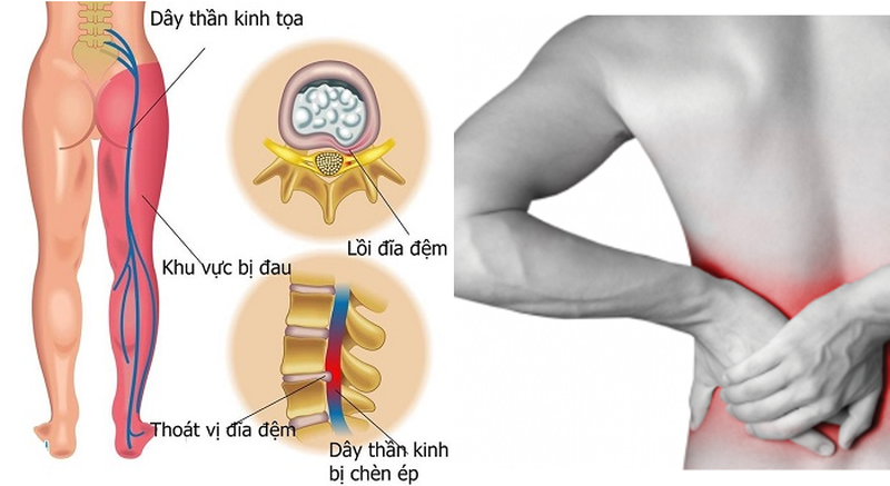 Thoát vị đĩa đệm là bệnh lý gây đau nhức và tê bì ở vùng lưng