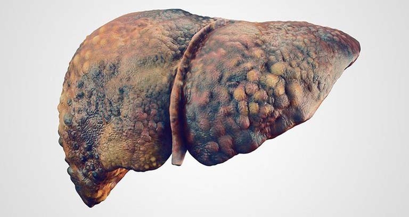 Người bị bệnh xơ gan F4 sống được bao lâu?3