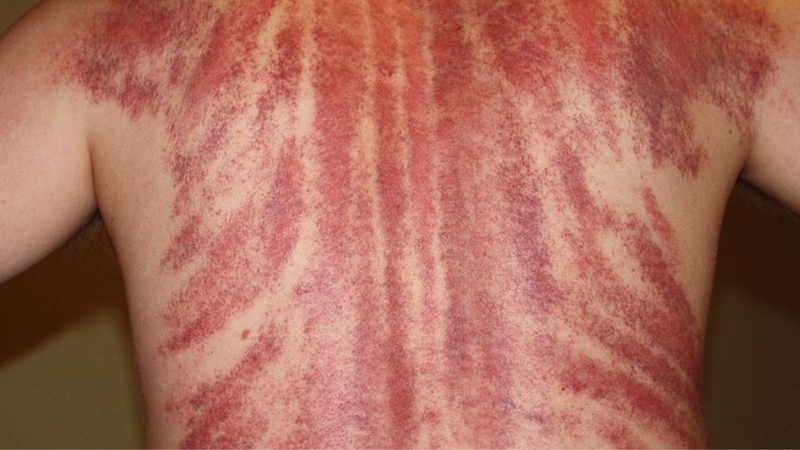 Người bị cao huyết áp có nên cạo gió? 1