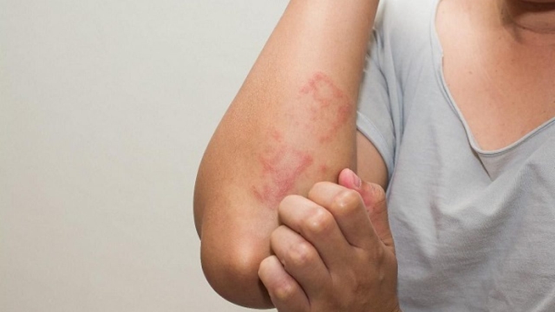 Dị ứng thời tiết rất hay gặp