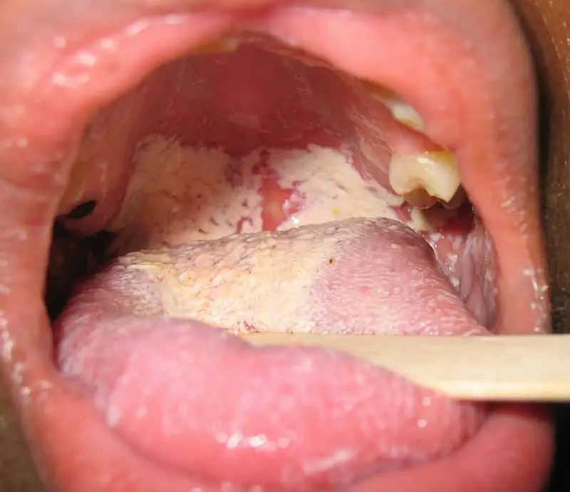 Người bị mắc bệnh lậu có chữa được không? 3