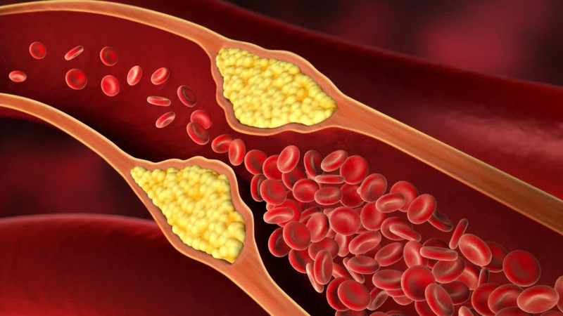Người bị mỡ máu cao phải kiêng hoàn toàn chất béo không? 2