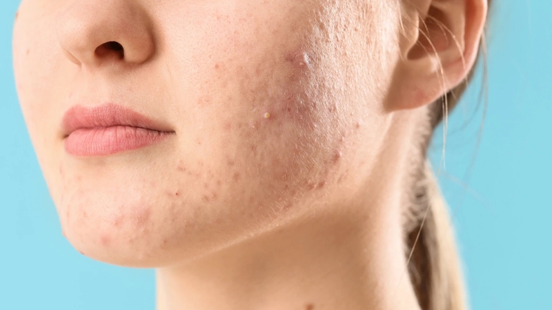 Mụn mủ xuất hiện khi hàng rào da yếu và bị vi khuẩn xâm nhập
