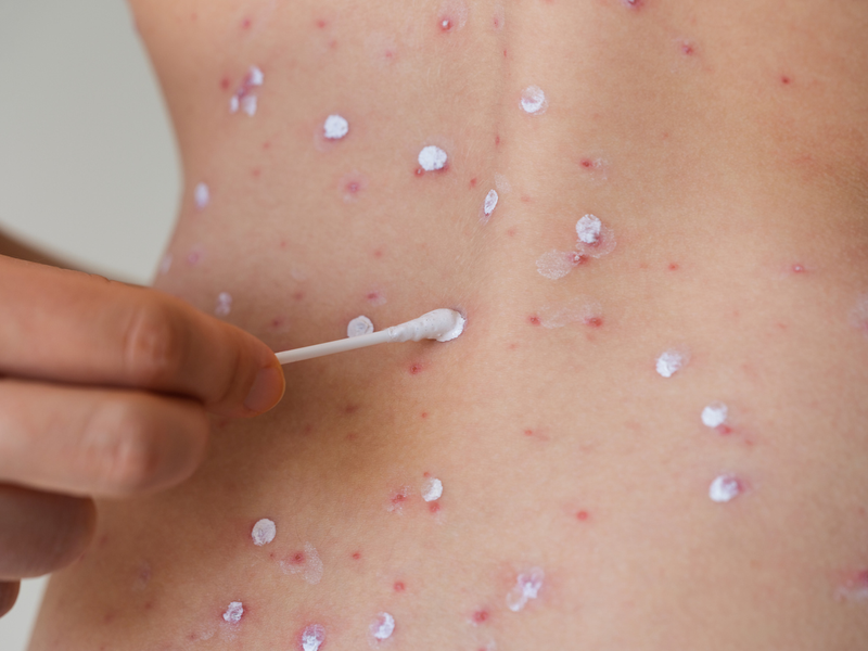 Người bị thuỷ đậu có bị tiêu chảy không? Tình trạng này nguy hiểm không?3