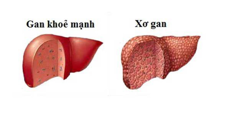 Người bị xơ gan có uống được mật ong không? 1
