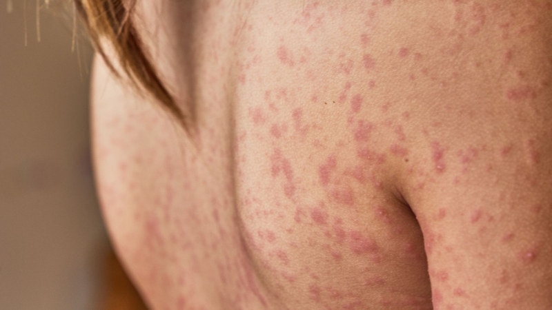 Người bị zona có ngứa không? Cách giảm triệu chứng ngứa của zona thần kinh 3