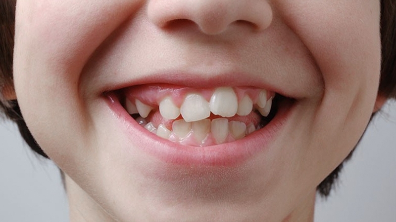 Người có 24 cái răng thì sao? Người thiếu răng có thể khiến hàm răng bị xô lệch, sai khớp cắn