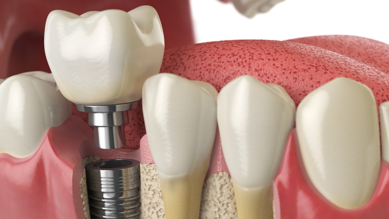 Cấy ghép implant cho răng bị mất là phương pháp tối ưu nhất hiện nay