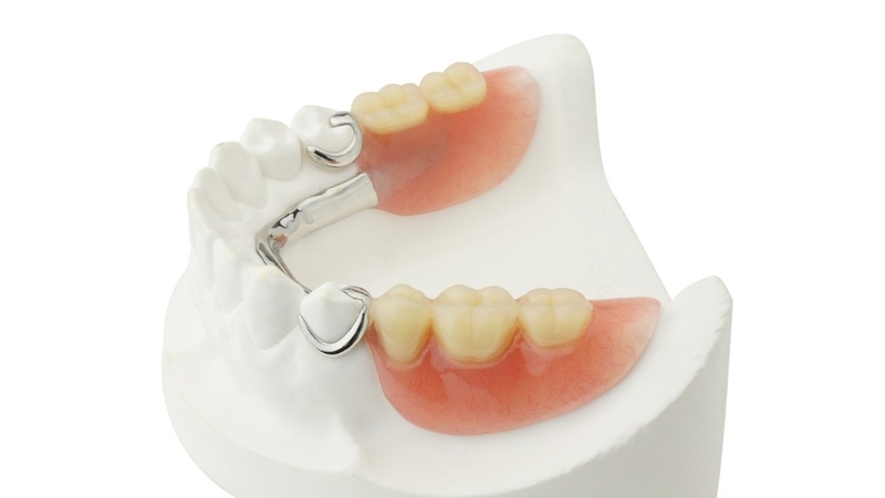Răng giả tháo lắp là lựa chọn tiết kiệm nhưng hiệu quả không cao