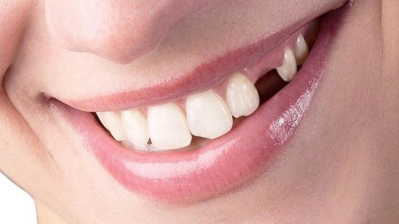 Mất răng do tai nạn hoặc bệnh lý khiến bạn có ít răng hơn bình thường