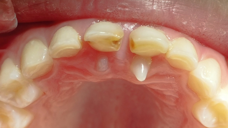 Trong quá trình phát triển thai nhi, mầm răng có thể hình thành nhiều hơn