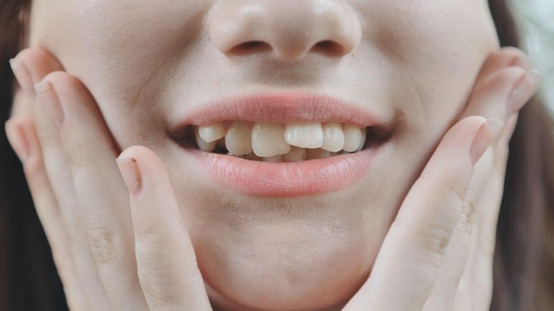 Người có 36 cái răng dễ mọc răng lệch lạc, chen chúc nhau