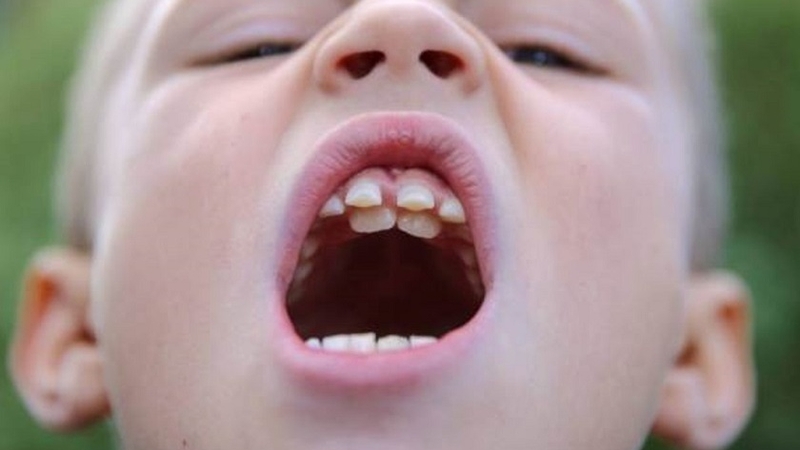 Người có 36 cái răng thì sao? Bác sĩ sẽ khám và nhổ bỏ răng thừa