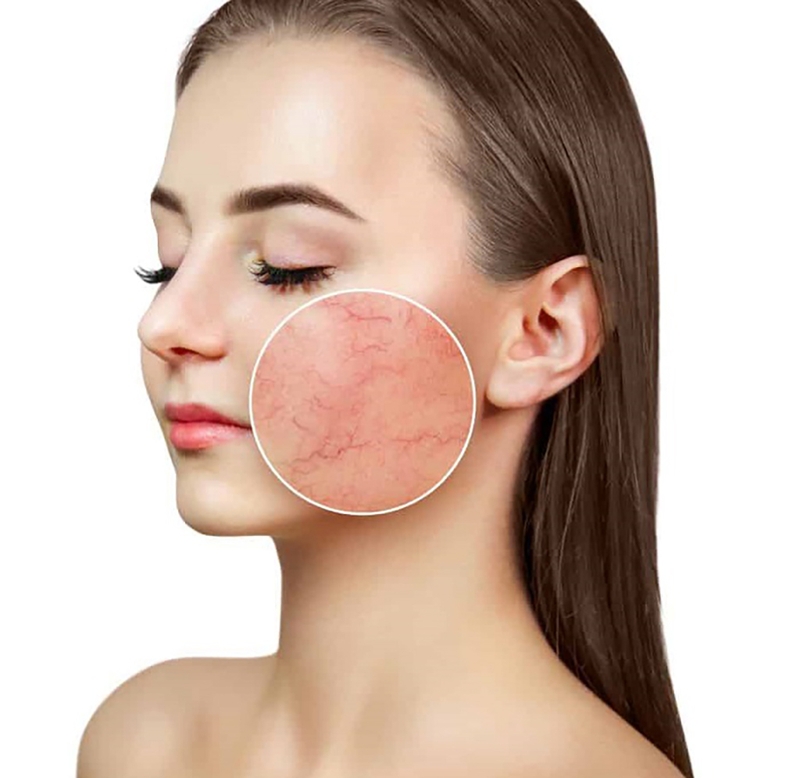 Người có làn da mỏng yếu có lăn kim được không?-3