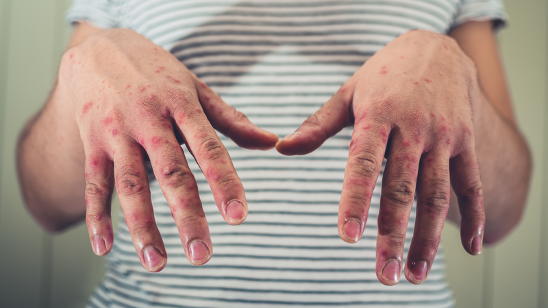 Người đã bị sởi có cần tiêm phòng sởi nữa không? 1