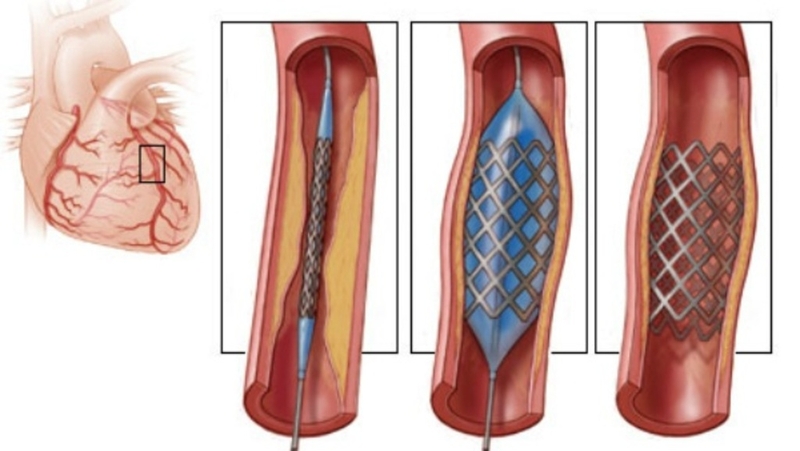 Người đặt stent mạch vành không nên ăn gì? Chế độ ăn hợp lý sau khi đặt stent 1