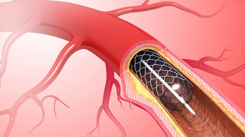 Đặt stent mạch vành là phương pháp can thiệp quan trọng nhằm xử lý tình trạng hẹp
