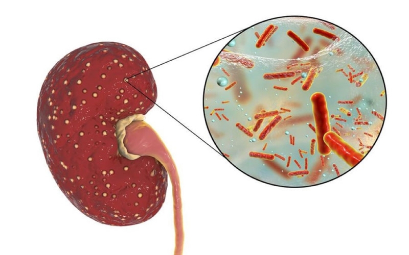 Người ghép thận sống được bao lâu? Những điều bệnh nhân ghép thận cần biết 4