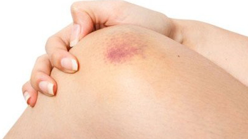 Giải đáp: Người hay bị bầm tím là thiếu chất gì?