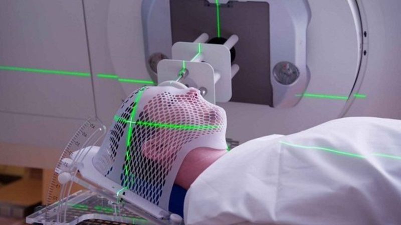 Xạ trị cũng có thể là nguyên nhân khiến lông mày bị rụng