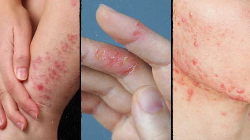 Người lớn có bị tay chân miệng không? Nguyên nhân và dấu hiệu 4