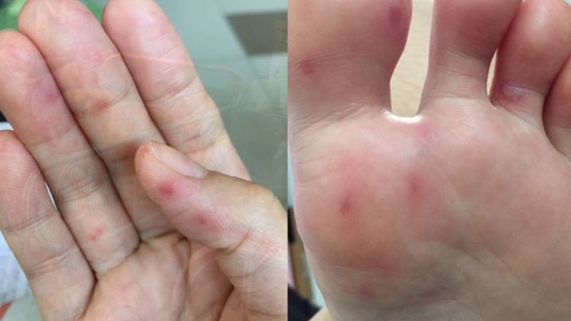 Người lớn có bị tay chân miệng không? Nguyên nhân và dấu hiệu 2