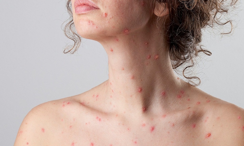 Người lớn có bị thủy đậu không và điều trị thế nào 2
