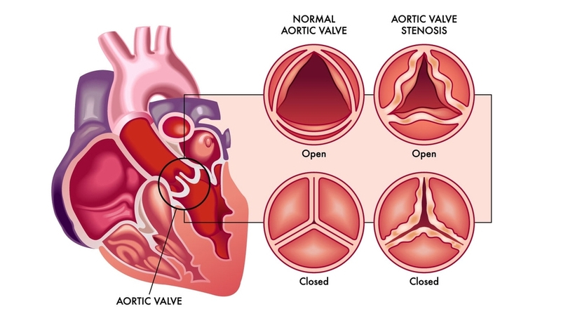 Người mắc bệnh hở van tim không nên ăn gì? Nên ăn gì để tốt cho sức khỏe tim mạch? 1