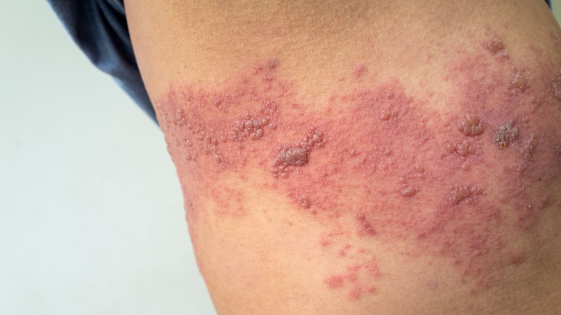 Người mắc ung thư tiêm vắc xin zona thần kinh: Nên hay không? 1