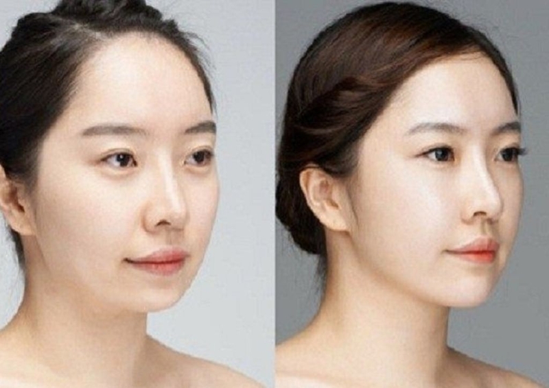 Tiêm filler cằm là gì? Một số lưu ý khi thực hiện tiêm filler cằm 1