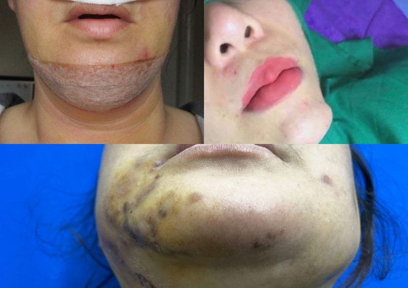 Tiêm filler cằm là gì? Một số lưu ý khi thực hiện tiêm filler cằm 2