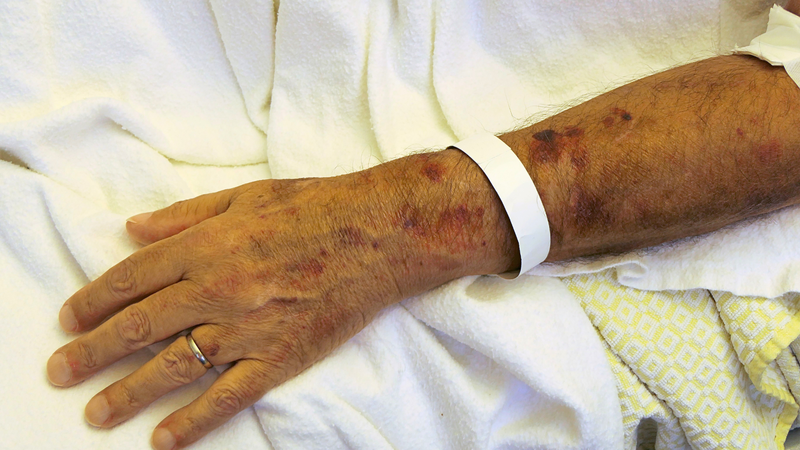 Nguy cơ bị nhiễm liên cầu lợn do ăn tiết canh 1