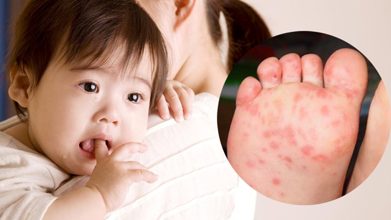 Nguy cơ bùng phát dịch bệnh tay chân miệng, sốt xuất huyết 1