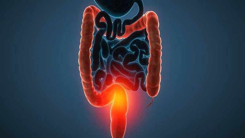 Nguy cơ thủng trực tràng do thải độc bằng thụt tháo cà phê 1