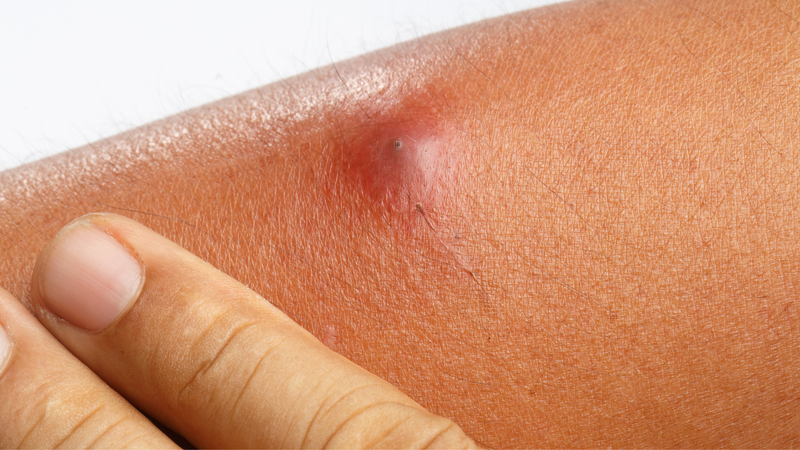 Áp xe vỡ tiềm ẩn tình trạng xuất hiện nhiều ổ áp xe vùng lân cận