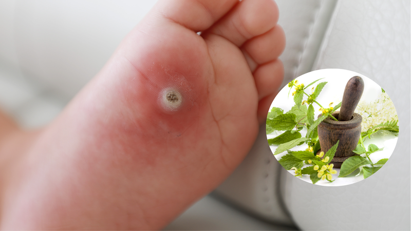 Không nên đắp lá thuốc không rõ nguồn gốc