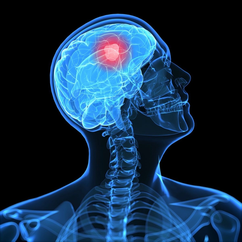 Nguy cơ và chẩn đoán u thần kinh trung ương ở trẻ em 1