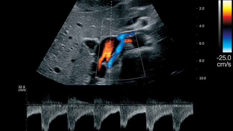 Nguyên lý siêu âm Doppler mạch: Cơ sở vật lý và ứng dụng lâm sàng 2