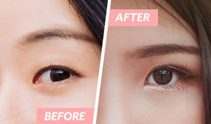 Nguyên nhân 2 mí mắt không đều? Cách làm 2 mí mắt đều nhau tại nhà? 3