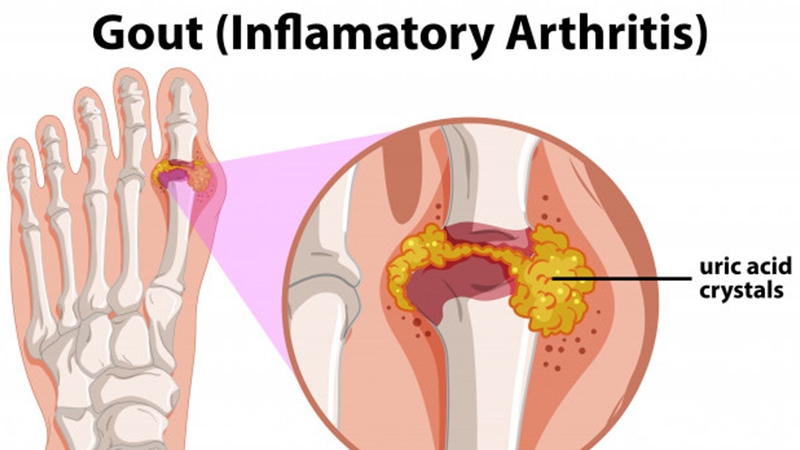 Nguyên nhân bệnh gout và cách nhận biết bệnh 2