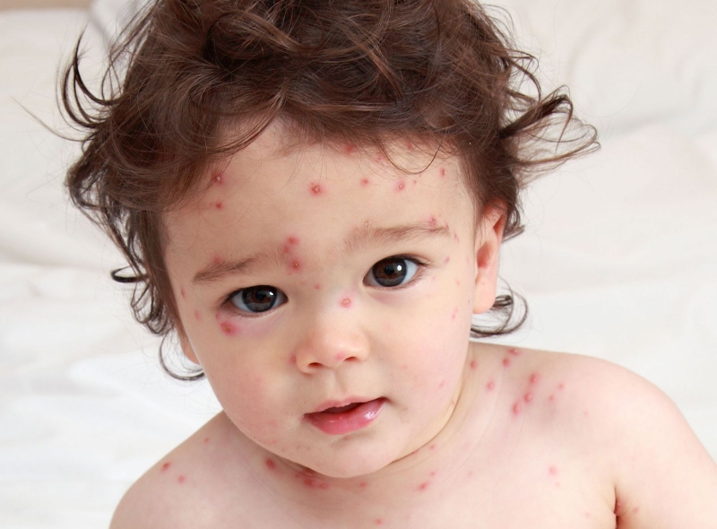 Bạn đã biết nguyên nhân bệnh sởi là gì chưa? 1