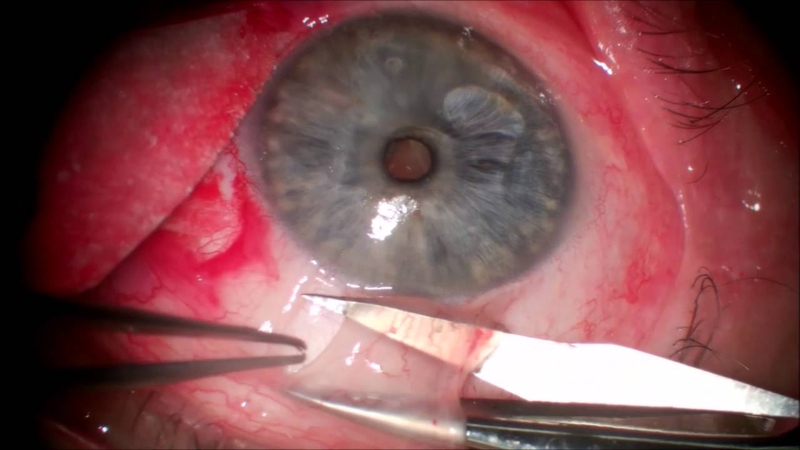 Nguyên nhân bị bệnh mộng thịt và nhiều nguy cơ mắc bệnh ngay trong môi trường sinh hoạt 3