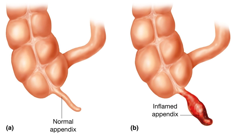 Nguyên nhân bị đau ruột thừa: Dấu hiệu nhận biết, phòng ngừa-1