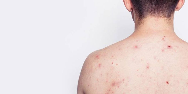 Nguyên nhân bị mụn lưng cần biết ngay và luôn 1