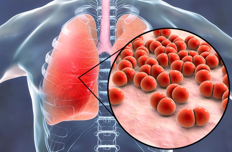 Nguyên nhân, cách chữa ho lâu ngày không khỏi ở người lớn và lưu ý khi điều trị 2
