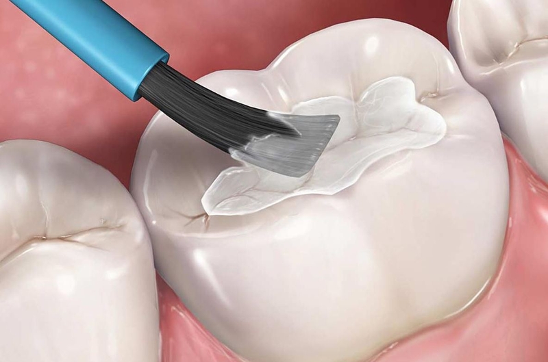 Trám răng sẽ giúp bảo vệ răng và hỗ trợ phục hình cho răng.