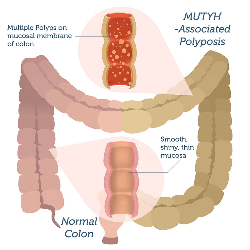 Nguyên nhân của bệnh đa Polyp liên quan gen MUTYH1