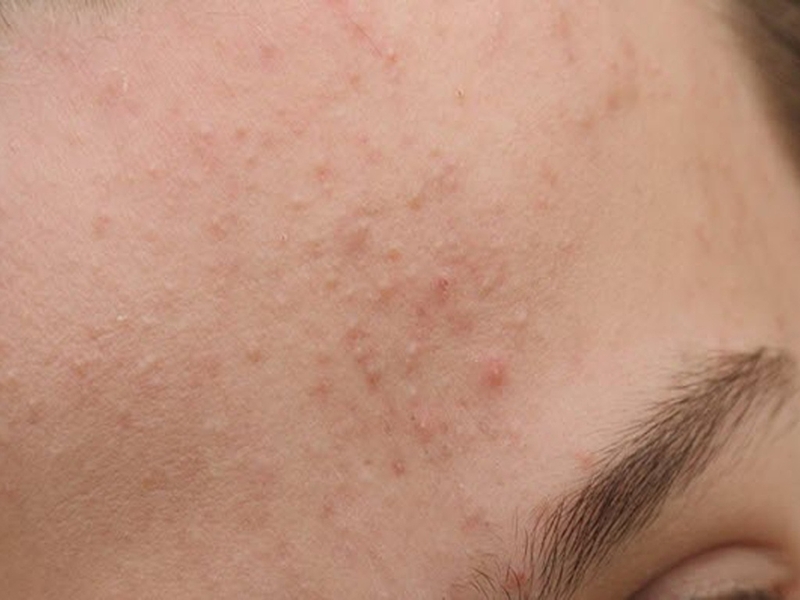 Nguyên nhân da mặt sần sùi nhiều mụn cám và cách điều trị 1